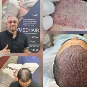 Турецкий центр трансплантации волос, бровей и бороды