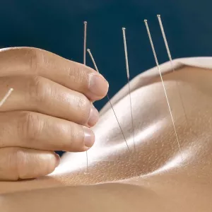 Иглоукалывание, иглотерапия, иглорефлексотерапия, акупунктура, обучение