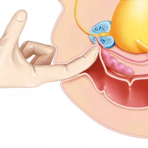 Урологический массаж, массаж простаты, обучение