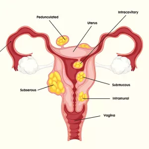 Umuthi Wenzalo, Health Concerns +27780201356 Including Sexually Transmitted Diseases (STDs) Female Fibroids