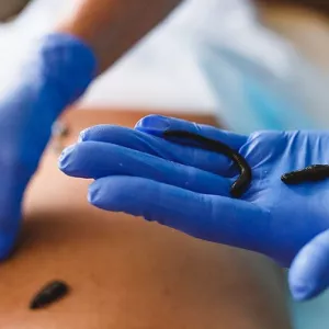 Лечение пиявками, гирудотерапия, гирудотерапевт