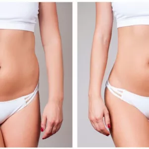 BodyTite: remodelare corporală fără bisturiu